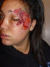 This is after they clean it up and apply sinthetic skin over wound