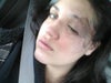 This is after first skin graft , also how it is currently, has healed up A LOT more