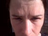 My forehead 2 weeks after 90 units to forehead, 11's and crows feet