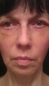 8- th day after surgery