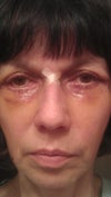 5-th day after surgery