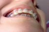 my overbite