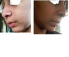 the side profile. 4weeks post op
