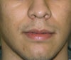i feel my philtrum makes me look older