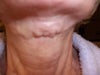 4 weeks after surgery