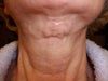 4 weeks after surgery