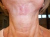 1 month after injection