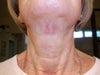 1 month after injection