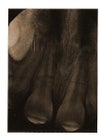 x-ray of cracked front teeth roots