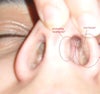 scar tissue inside, deviated septum? and the nasal wall seems to be bumpy rather than smooth