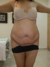 Pre Sept  (2nd) surgery