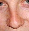 My nose pre-srugery
