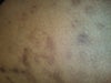 This is a picture of my arm near shoulder