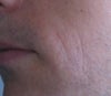 I also have lines that are getting worse around my mouth that age me 10 years and all started at the same time as the neck and ear lines..over the last year.