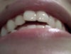 two front teeth being pushed forward