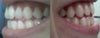 left side, right side when I bite down