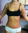 24 hours post op. no bumps