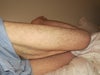 Inner thigh loose skin