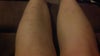 this is the picture of my legs this was probably the worst place i got the infection