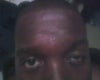 you see the huge difference in my eyes and my eye brows. i'm going to take a picture around midday when the sun is out to show how my left eye brow lefts all the way up but my eye lid is still smaller than my right.