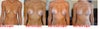 Side by side comparison, First Surgery 4/2010, Second Surgery 5/2011, Third Surgery 11/2011