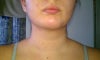 Day 10 post op
