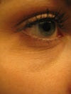 I've always had some under eye darkness and bags, but now I'm seeing lines, loss of resiliency, and crepiness.