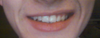 Crooked Smile