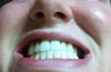 My crossbite