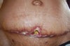 without the intrasite gel filled in