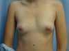 Pre-op