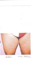 These were my inner tights when they never were touch by a surgeon.