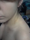 marks left on my shoulder from my bra...also shows my shoulders have been pulled forward.