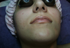 Photo taken before a facial from about a year ago. I think i've broken out since and have more hyper pigmentation scars than appear in the picture.