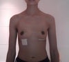 2 weeks after explant