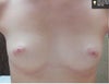 Before implants