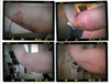 The first square is the day after surgery.It looked better than next day than it does now. Each picture is a week apart, the last one was taken this morning.