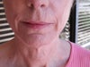 Wrinkles around lips and (  ) folds around mouth