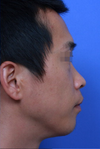 Side dorsal profile.
