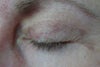indentation appeared after blephoroplasty
