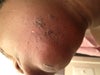 Chin Burn