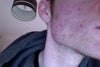 after three months of antibiotic and cream