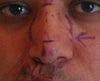 before surgery