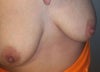 Before Surgery