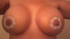 1 week post-op