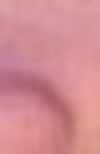 nose/columella before surgery