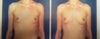 photo before and a 3D-animation with anatomic implant Allregan Natrelle 220 cc ML