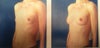 photo before and a 3D-animation of anatomic implant Allergan Natrelle 220 cc ML