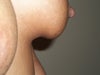soft breast tissue hanging over crease