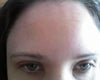 Horizontal forehead lines that developed 2 years after I began getting Botox every 10 weeks